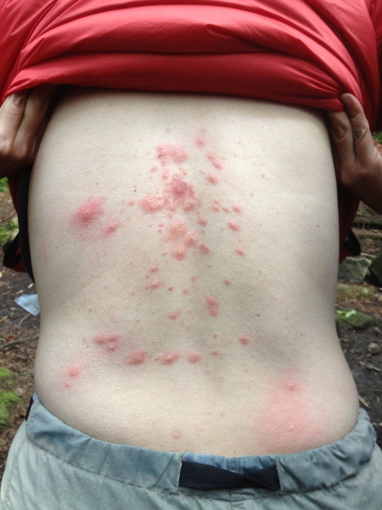 Bed Bug Bites
