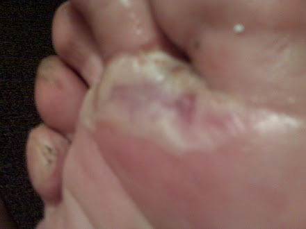 Foot Blisters